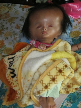 Cô bé 4 tuổi đầu to và nặng gấp đôi cơ thể