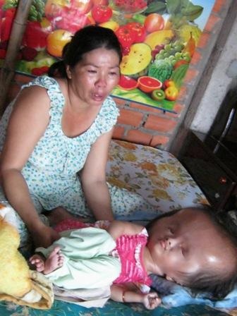 Cô bé 4 tuổi đầu to và nặng gấp đôi cơ thể