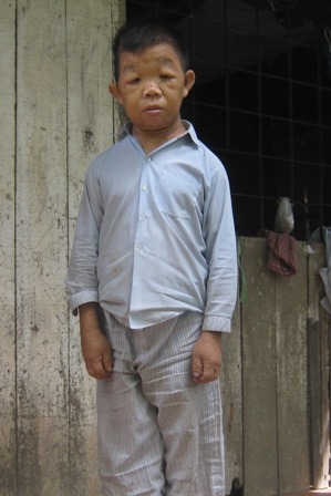 Anh Dân đã 45 tuổi nhưng có vẻ ngoài như một đứa trẻ 9 - 10 tuổi