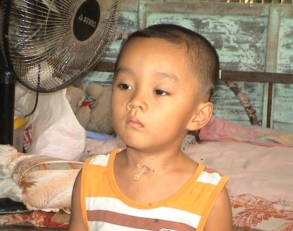 Bé Lỹ Nguyễn Anh Duy đã được thay “ống thở’ mới
