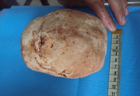 Bác sĩ “ngã ngửa” với viên sỏi trong bàng quang nặng gần 1 kg