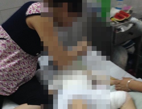 Tạm đình chỉ 2 cô giáo trong vụ bé gái mầm non bị bạn đốt bỏng - 1 Bé L. vừa trải qua lần phẫu thuật đầu tiên.