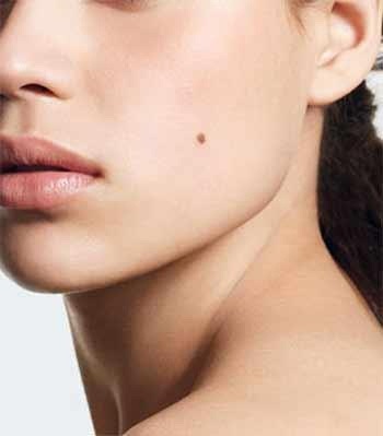 Tẩy nốt ruồi, chưa kịp thay đổi vận mệnh đã rước họa - 1 Tẩy nốt ruồi, chưa kịp thay đổi vận mệnh đã rước họa - 1