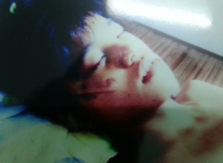 Đề nghị điều tra vụ một thanh niên bị hành hung dã man ở thị xã Từ Sơn - 1 Ảnh Nguyễn Văn Thanh bị hành hung khi đang điều trị tại bệnh viện