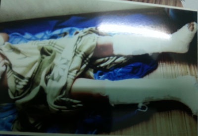 Đề nghị điều tra vụ một thanh niên bị hành hung dã man ở thị xã Từ Sơn - 3 Cháu Thanh bị một nhóm người đánh dập nát toàn bộ xương cổ tay, cổ chân