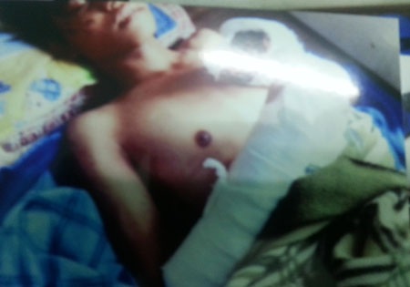 Đề nghị điều tra vụ một thanh niên bị hành hung dã man ở thị xã Từ Sơn - 2 Cháu Thanh bị một nhóm người đánh dập nát toàn bộ xương cổ tay, cổ chân