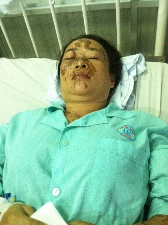 Chị Tăng Túy Hà là một trong 2 nạn nhân bị bỏng nặng nhất
