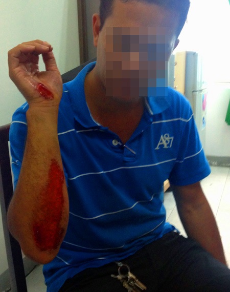 Thượng uý Nguyễn Hữu Hoàng Minh với vết thương ở tay do lao xe vào 2 tên cướp giật