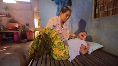 Nỗi đau da cam của thành phố biển Đà Nẵng trên báo nước ngoài - 1 Nạn nhân tên Huyen, 30 tuổi, luôn phải được mẹ chăm sóc