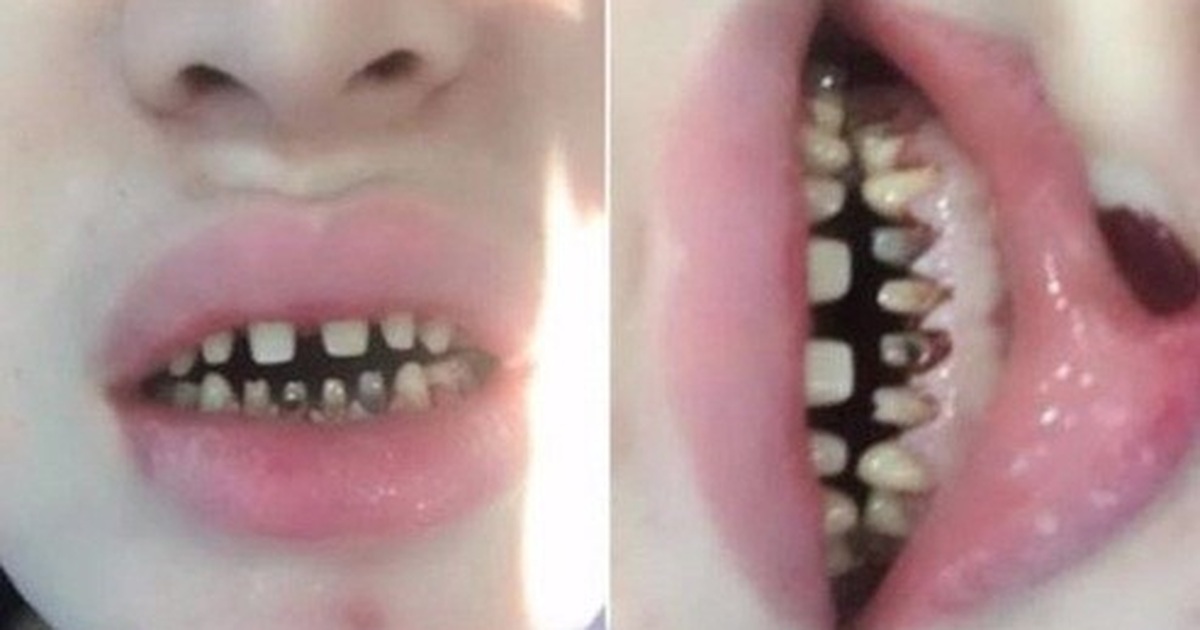 Bọc răng sứ thẩm mĩ và những hiểu lầm tai hại cần biết! | Báo Dân trí