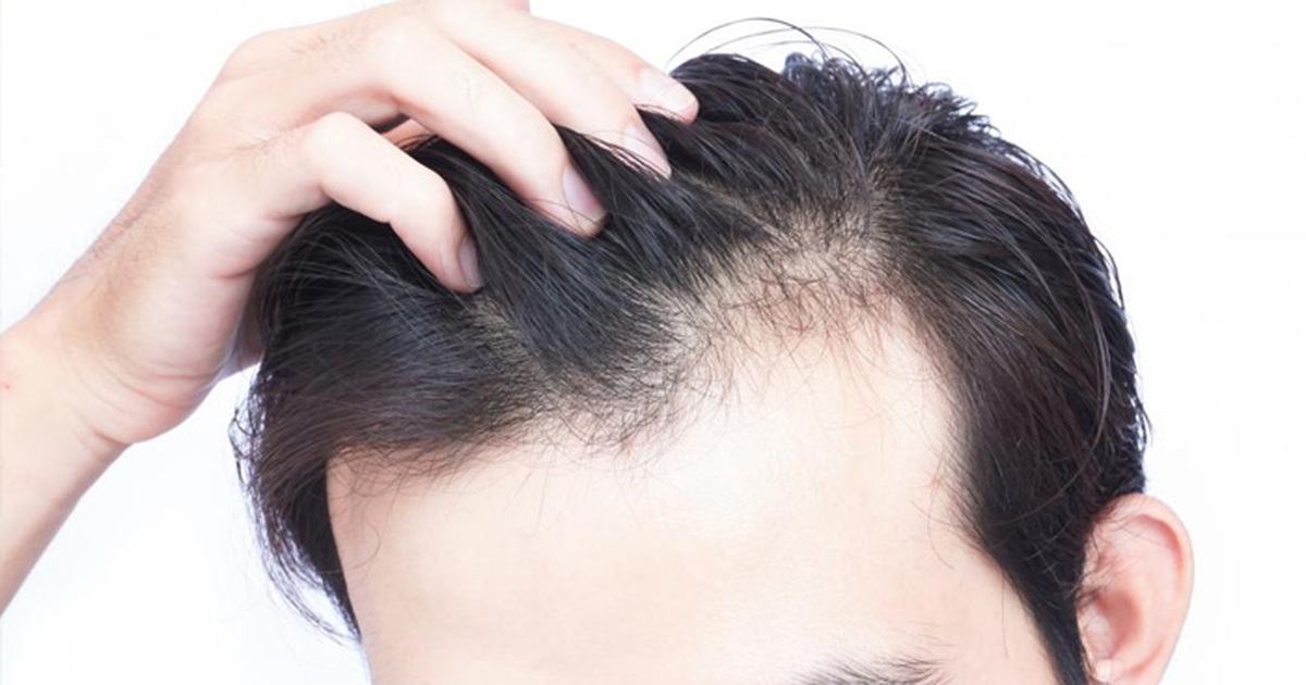 Hói đầu nam Dấu hiệu nguyên nhân và cách khắc phục hiệu quả  VIỆN CẤY TÓC  TỰ THÂN NEWHAIR BY KHƠ THỊ