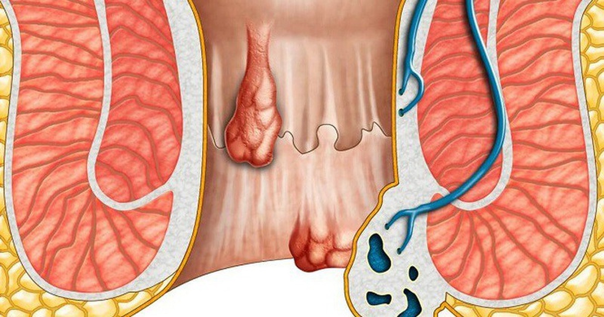 Triệu chứng ung thư hậu môn giai đoạn đầu | Báo Dân trí