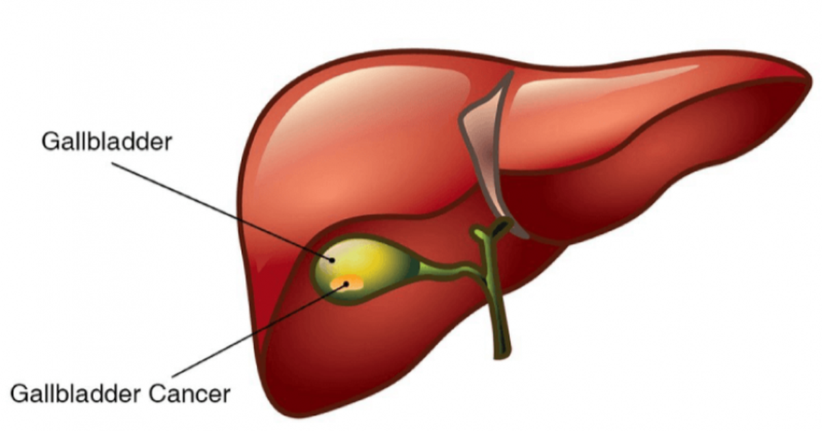 Желчный пузырь глаза. Опухоль желчного пузыря. Злокачественная опухоль желчного пузыря. Доброкачественные опухоли желчного пузыря.