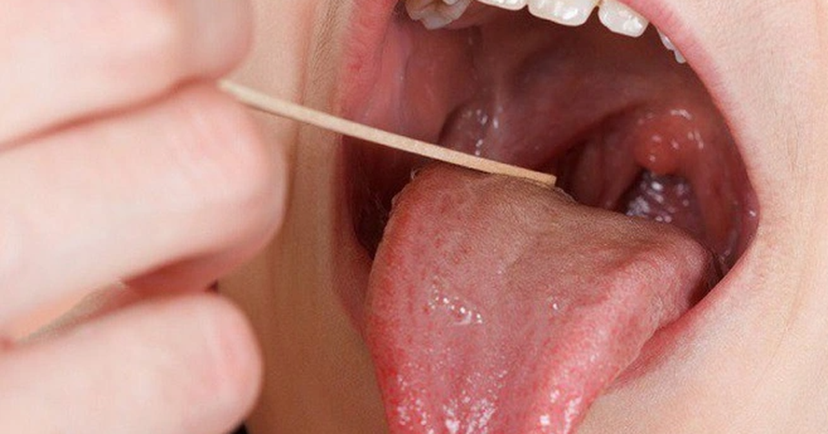 Những triệu chứng cần nghĩ ngay đến ung thư lưỡi | Báo Dân trí