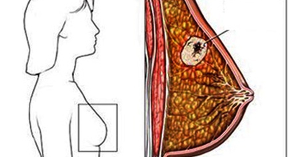 Как выглядит уплотнение в молочной железе у женщин при раке фото