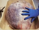Choáng váng với khối u 22 kg lấy ra từ cơ thể bệnh nhân lạc nội mạc tử cung