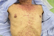 Nở "hoa gấm", bọng nước toàn thân sau liều thuốc mua trên mạng