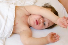 42 ca mắc bệnh, Bộ Y tế yêu cầu tiêm bù tiêm vét vaccine phòng sởi