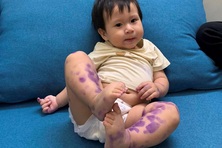 Cảnh báo dịch tay chân miệng "vào mùa"