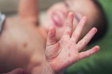Nguyên tắc bắt buộc phải nhớ khi theo dõi trẻ mắc tay chân miệng tại nhà