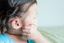 Cảnh báo gia tăng ca mắc mới và ổ dịch mới các bệnh truyền nhiễm