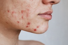 Nguy cơ bị mụn trứng cá nặng hơn khi uống sữa