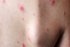 Ho Chi Minh City records first monkeypox case of 2026