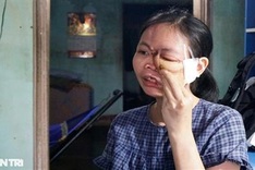 Woman with distorted face in Binh Dinh needs help