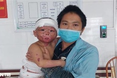 Dantri/DTiNews readers support seriously-burnt little girl