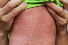 Ministry asks for preparation of measles outbreak