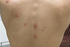 Ministry warns of monkeypox outbreak