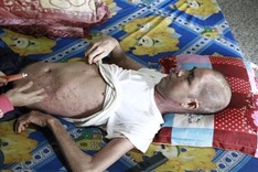 Dak Lak man suffers from psoriasis and stroke effects