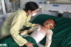 Boy suffering serious burns gets support