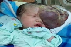 Woman seeks help for newborn baby with abnormal face