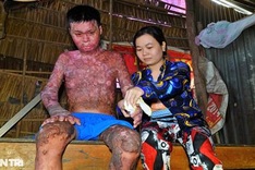 Seriously-burnt man in Hau Giang in desperate need of support