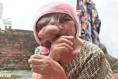 Woman with disfiguring facial tumour needs help