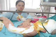 Ill boy continues suffering from fire burns