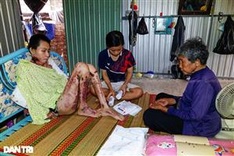 Woman needs support to treat severe burns