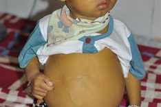 Poor boy receives support for liver transplant