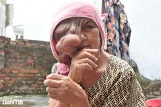 Woman receives support to remove disfiguring facial tumour