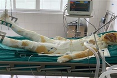 Burn victims in desperate need of help to survive