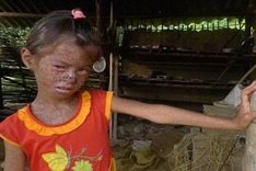 Pain of small girl in Bac Giang living with strange skin disease