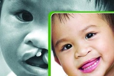 Operation Smile to raise funds for 500 surgeries