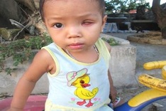 Little girl struggles with eye cancer