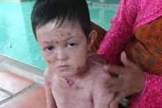 Little 'butterfly child' fights rare skin disease