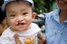 Operation Smile to visit An Giang in April