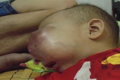 Little girl suffers from large tumour