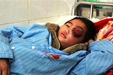 Little girl with eye deformity receives strong support