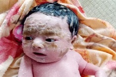 Brothers suffer from fish scale disease