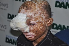 Teenager suffers from skin cancer